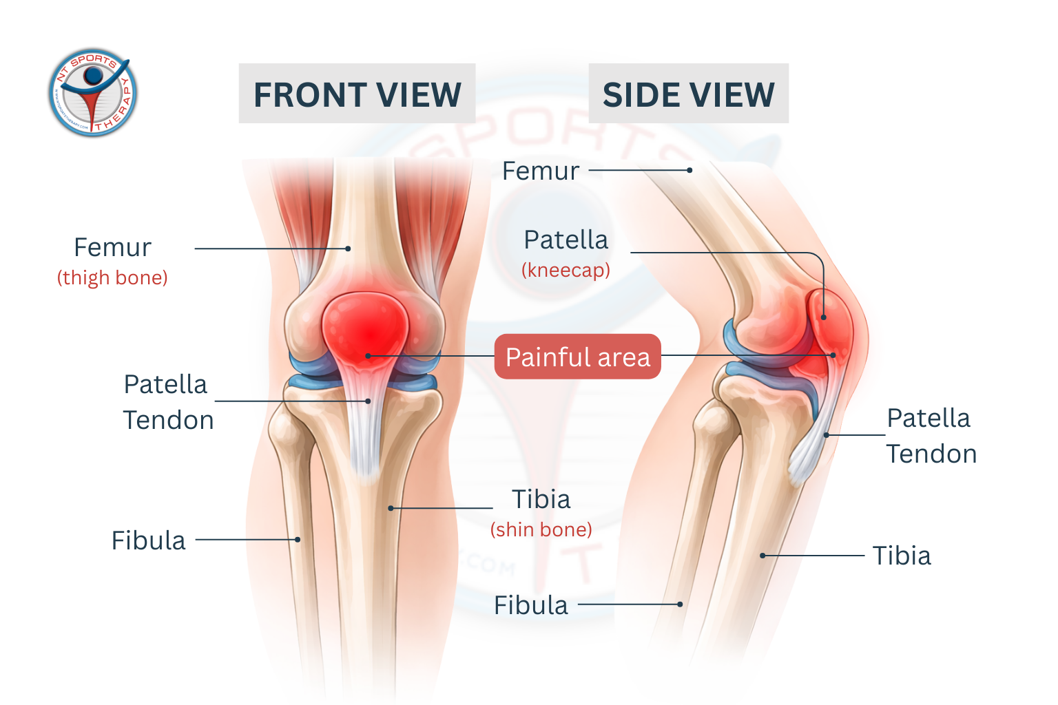 Runners_Knee_Diagram